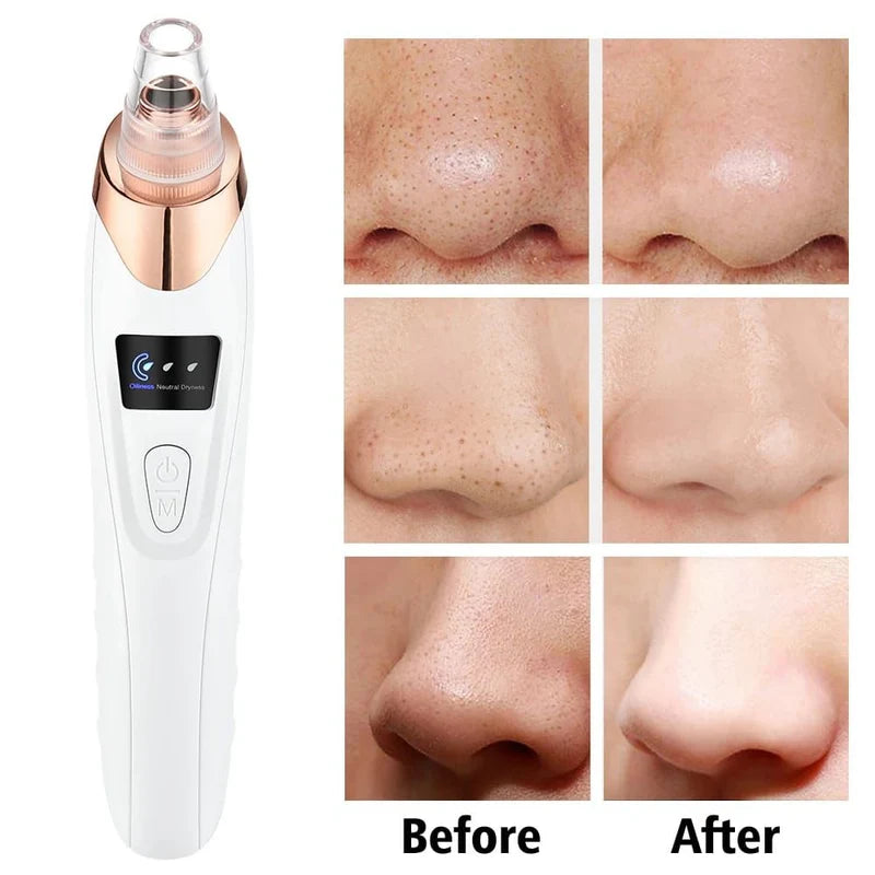 Electric Blackhead Remover – 5-Head Pore Cleaner & Facial Vacuum for Skincare