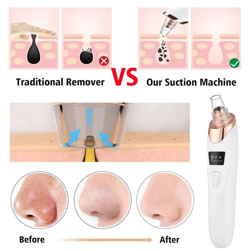 Electric Blackhead Remover – 5-Head Pore Cleaner & Facial Vacuum for Skincare